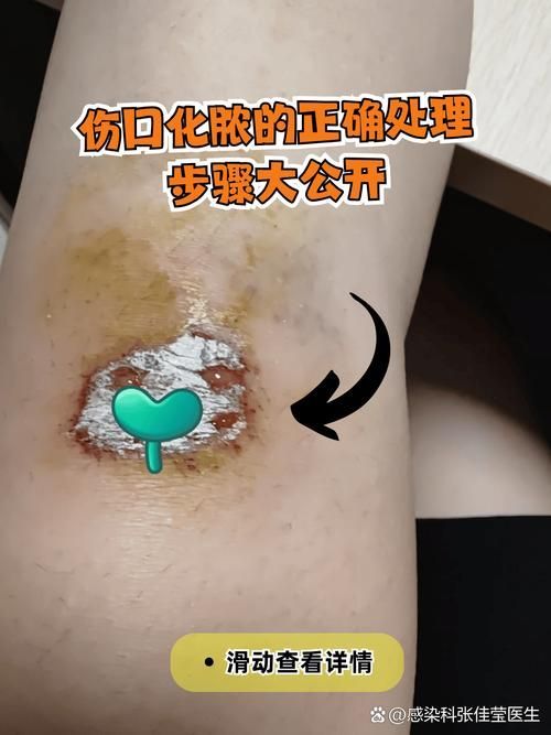 傷口感染后如何治療，傷口感染后的處理
