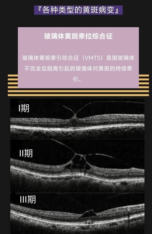 蒙眼病有哪些癥狀，“蒙眼病”并非醫學術語并非醫學術語并非醫學術語