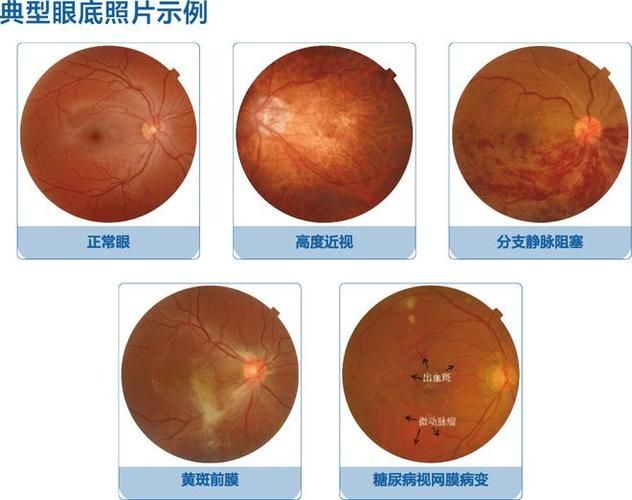 蒙眼病有哪些癥狀，“蒙眼病”并非醫學術語并非醫學術語并非醫學術語