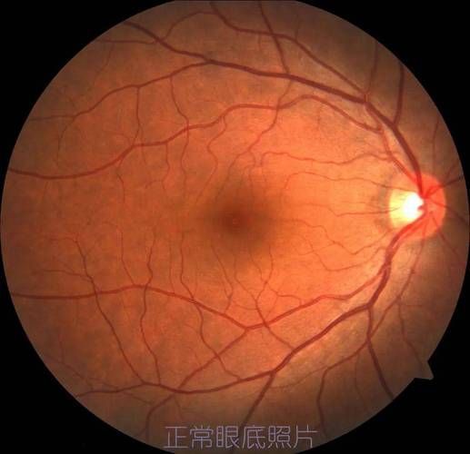 蒙眼病有哪些癥狀，“蒙眼病”并非醫學術語并非醫學術語并非醫學術語