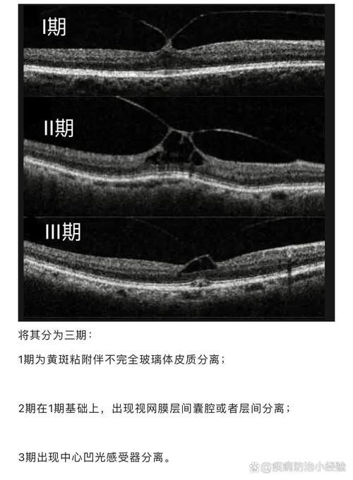蒙眼病有哪些癥狀，“蒙眼病”并非醫學術語并非醫學術語并非醫學術語