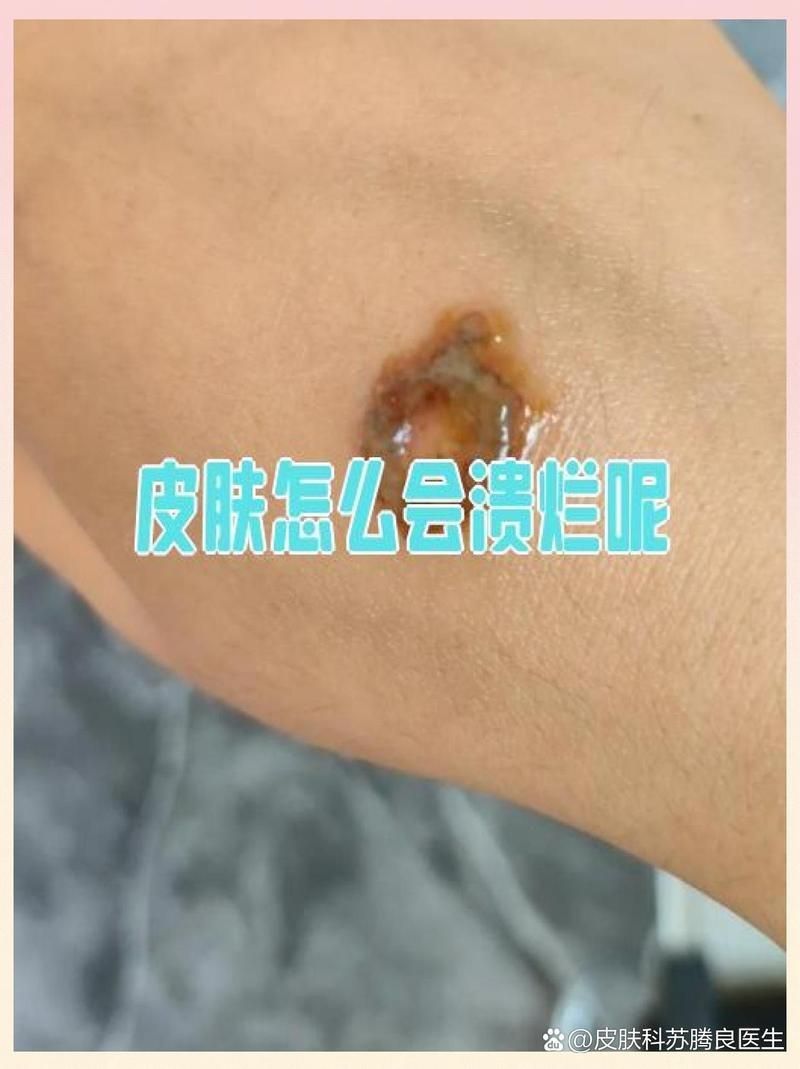 潰爛病有哪些治療方法，潰爛病治療方法