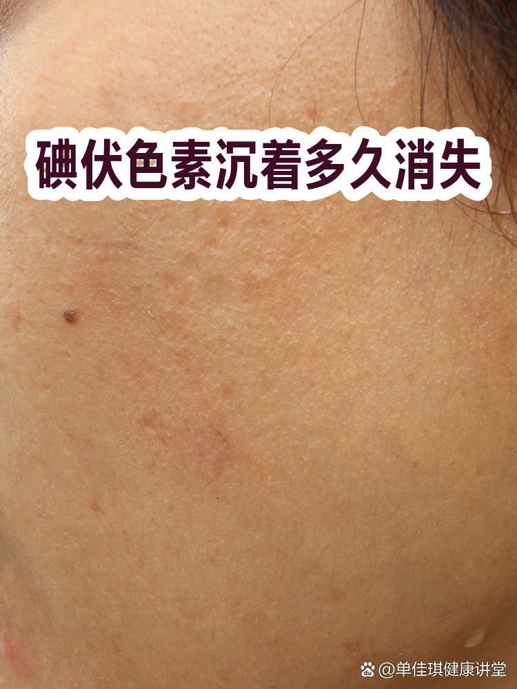 碘伏殘留多久會自行消失