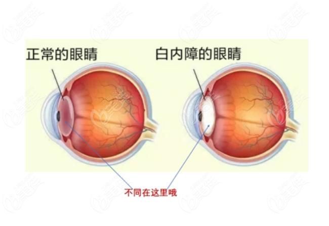 蒙眼病治療需要多長時間，“蒙眼病治療需要多長時間對比圖、角膜炎治療需要多長時間”