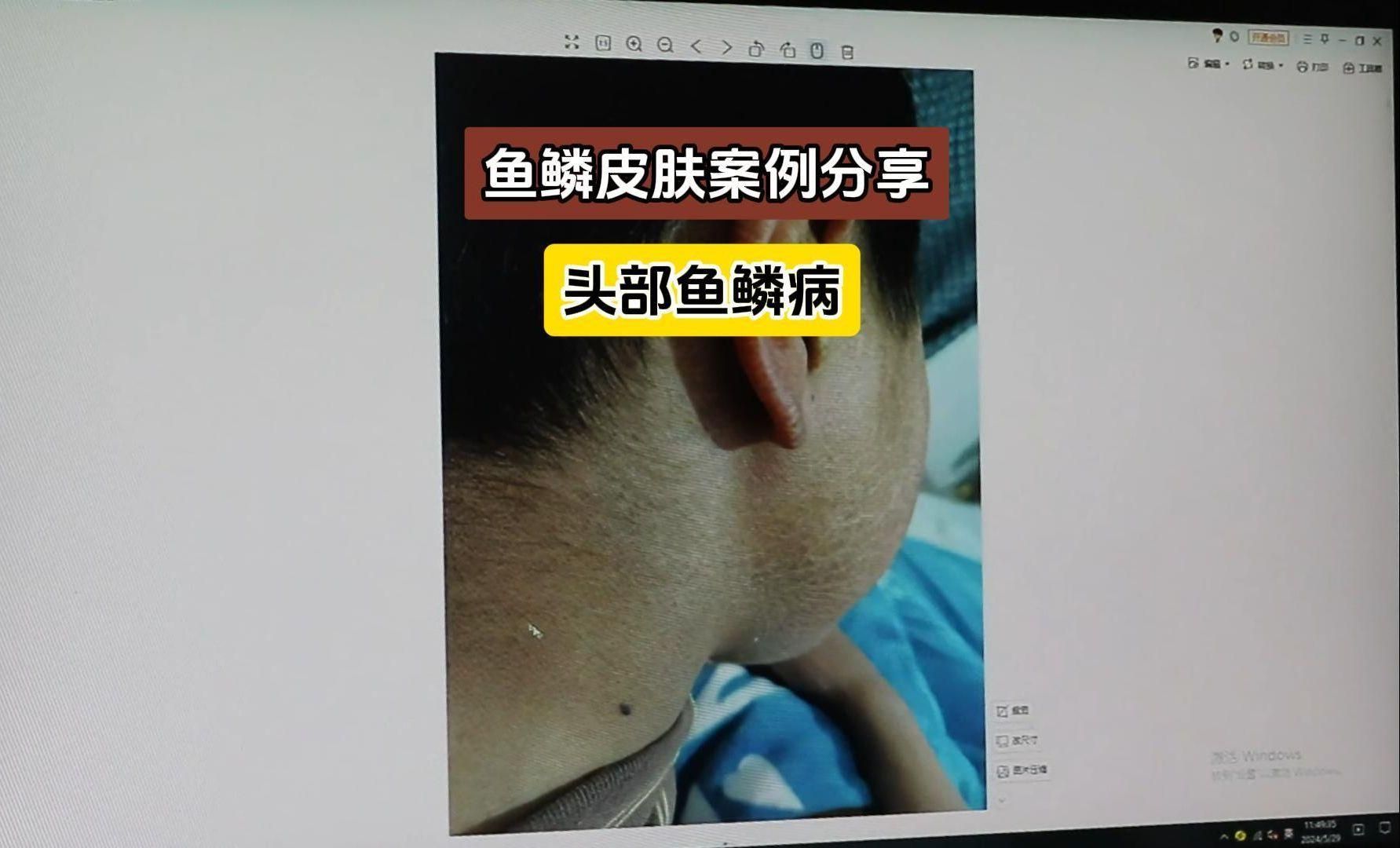 如何判斷魚(yú)鱗病是否完全治愈