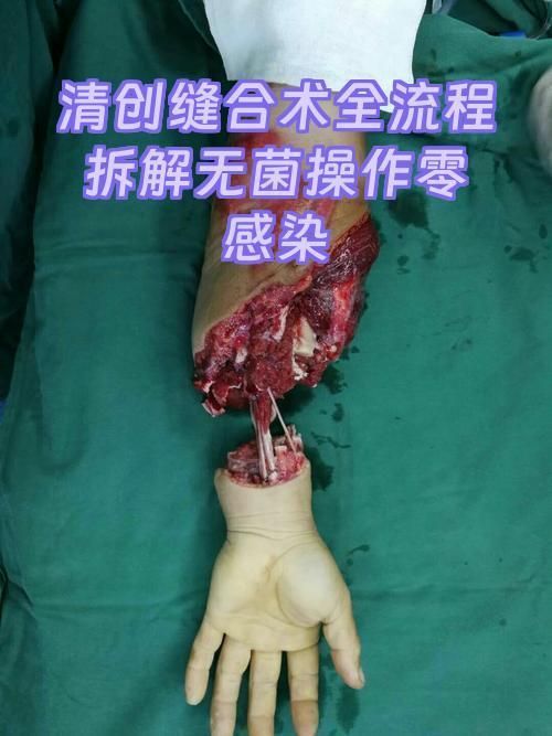 能否提供清創手術的詳細步驟，清創手術是一種外科手術，清創手術的詳細步驟是什么
