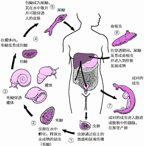 大肚子病如何預防，“大肚子病”在醫學語境中主要指晚期血吸蟲病晚期表現