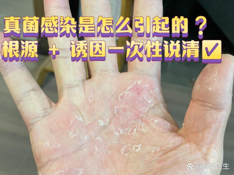 真菌和細菌哪個更容易復(fù)發(fā)，真菌和細菌哪個更容易復(fù)發(fā)，