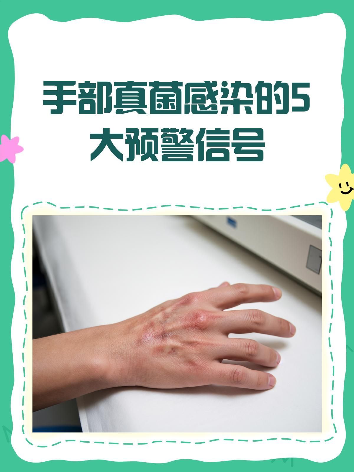 手部真菌感染的癥狀有哪些，手部真菌感染的5大預警