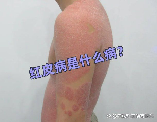 紅斑病和赤皮病有何區別，紅斑病與赤皮病的區別