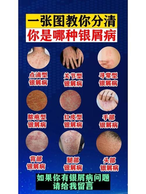 有哪些品牌治療爛鱗的藥物推薦，皮膚疾病治療之爛鱗