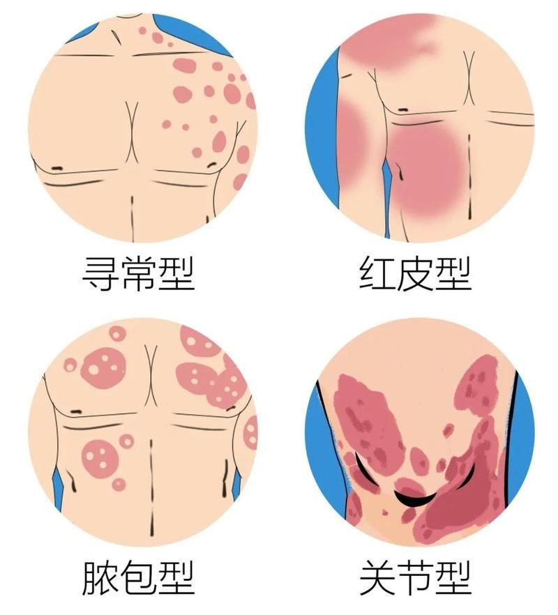 有哪些品牌治療爛鱗的藥物推薦，皮膚疾病治療之爛鱗