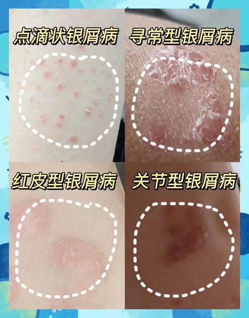 有哪些品牌治療爛鱗的藥物推薦，皮膚疾病治療之爛鱗
