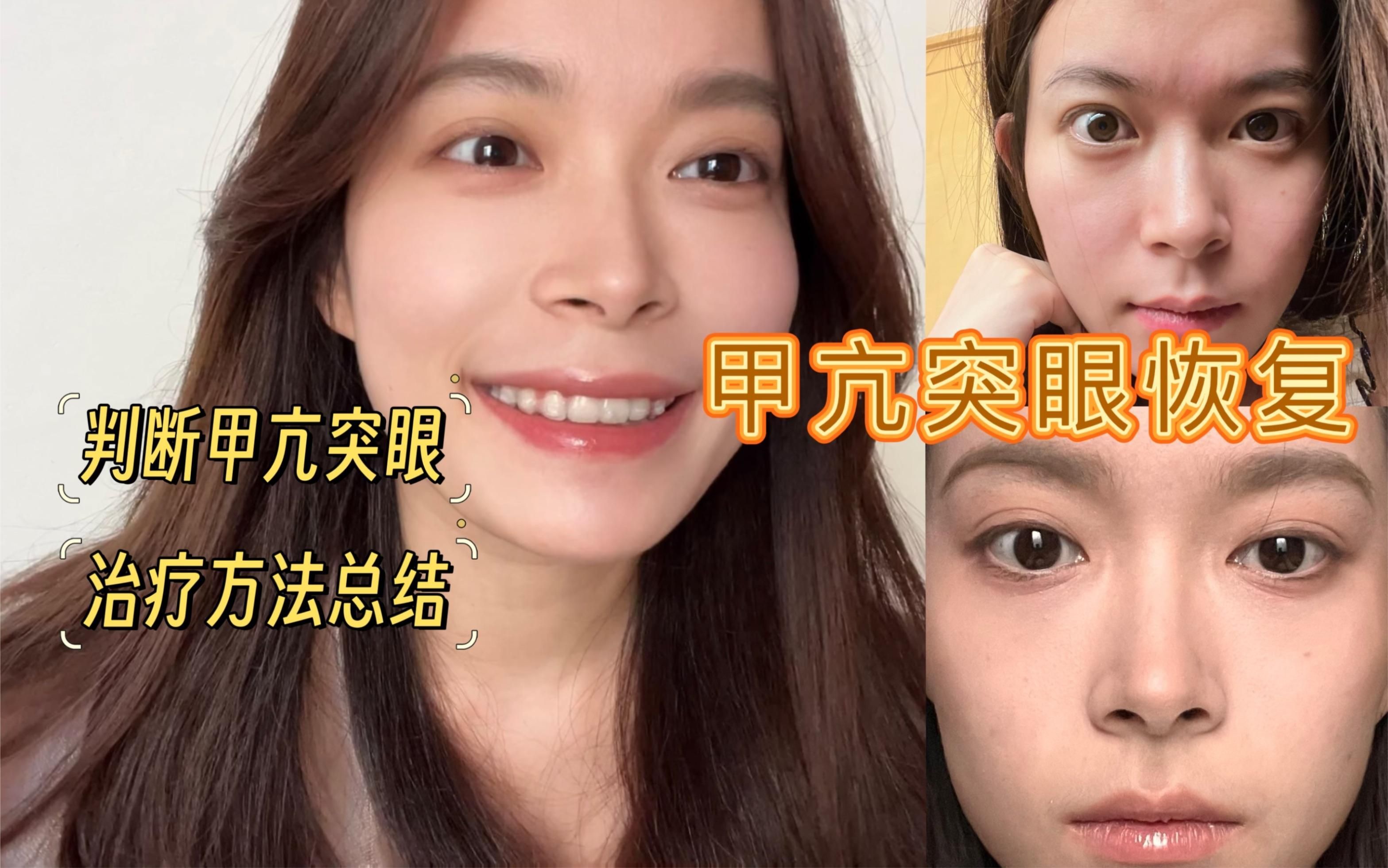 中度突眼如何治療最有效，中度突眼如何治療