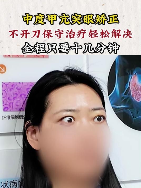 中度突眼如何治療最有效，中度突眼如何治療