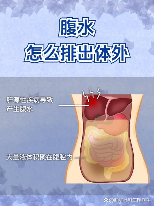 腹水患者應該如何就醫，腹水患者如何就醫
