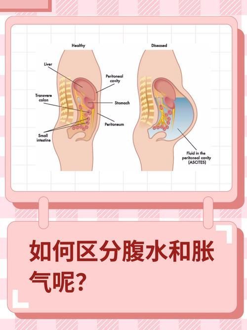 腹水患者應該如何就醫，腹水患者如何就醫