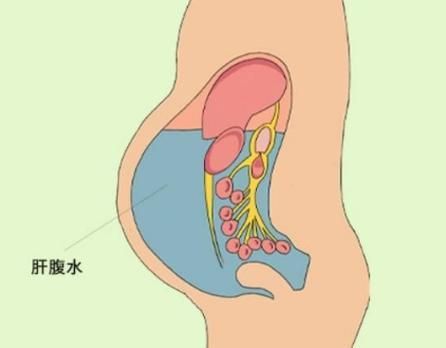 腹水患者應該如何就醫，腹水患者如何就醫