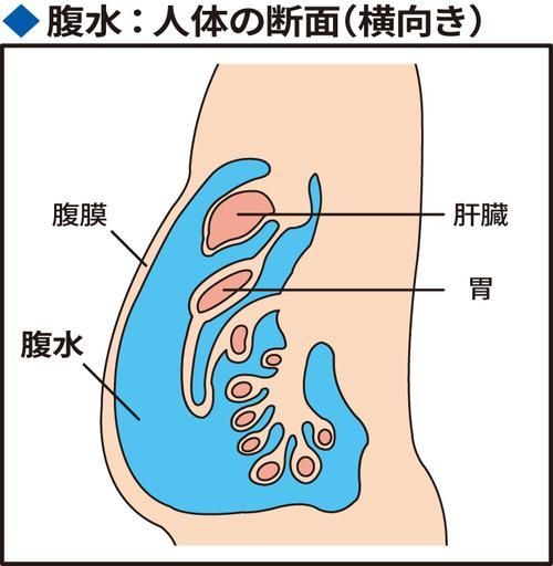 腹水患者應該如何就醫，腹水患者如何就醫