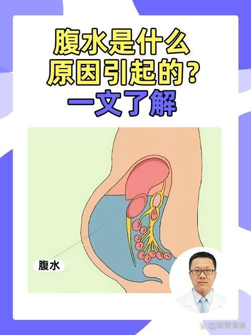 腹水患者應該如何就醫，腹水患者如何就醫