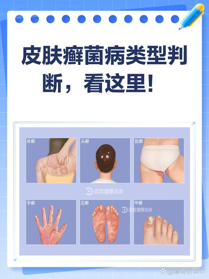如何判斷自己是否感染了皮膚癬菌病，如何判斷自己是否感染了皮膚癬菌病皮膚癬菌病的典型表現