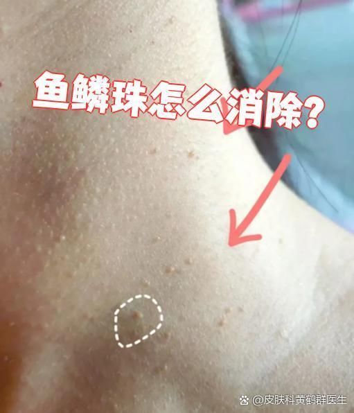 哪種方法去除魚鱗珠最快，哪種方法去除魚鱗珠最快本探討了快速去除魚鱗珠的方法