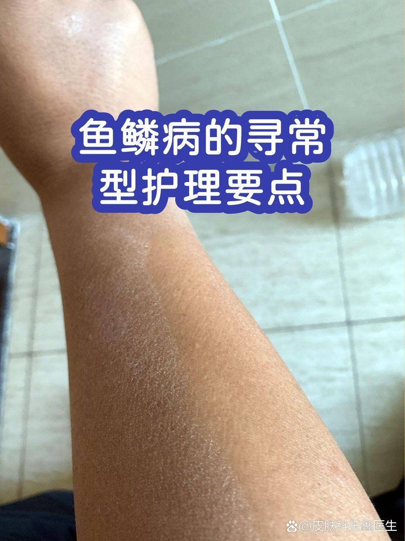 如何緩解魚鱗病癥狀