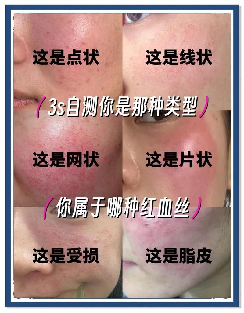 如何判斷自己的紅血絲類型，如何判斷自己的紅血絲類型，如何區分單純毛細血管擴張和疾病伴隨型