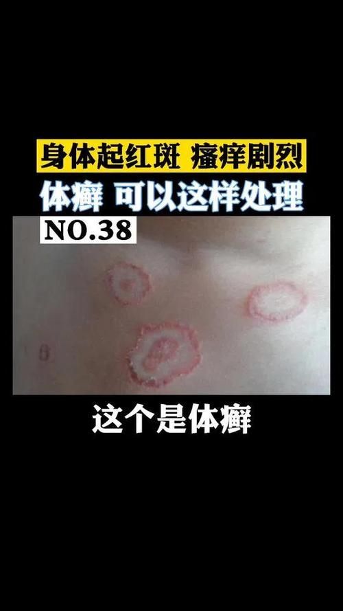 如何預防和治療皮膚癬菌病，關于皮膚癬菌病治療的一些建議
