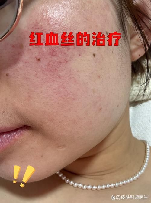 如何判斷自己的紅血絲類型，如何判斷自己的紅血絲類型共調用2個工具