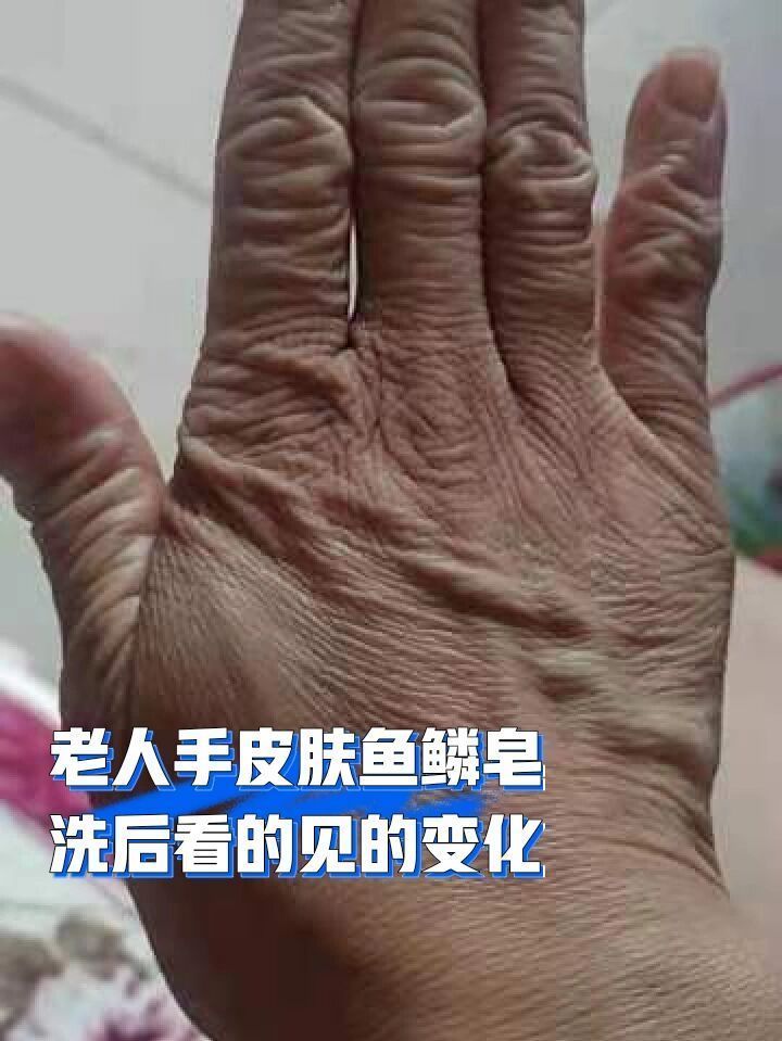 手上長魚鱗怎么去除掉