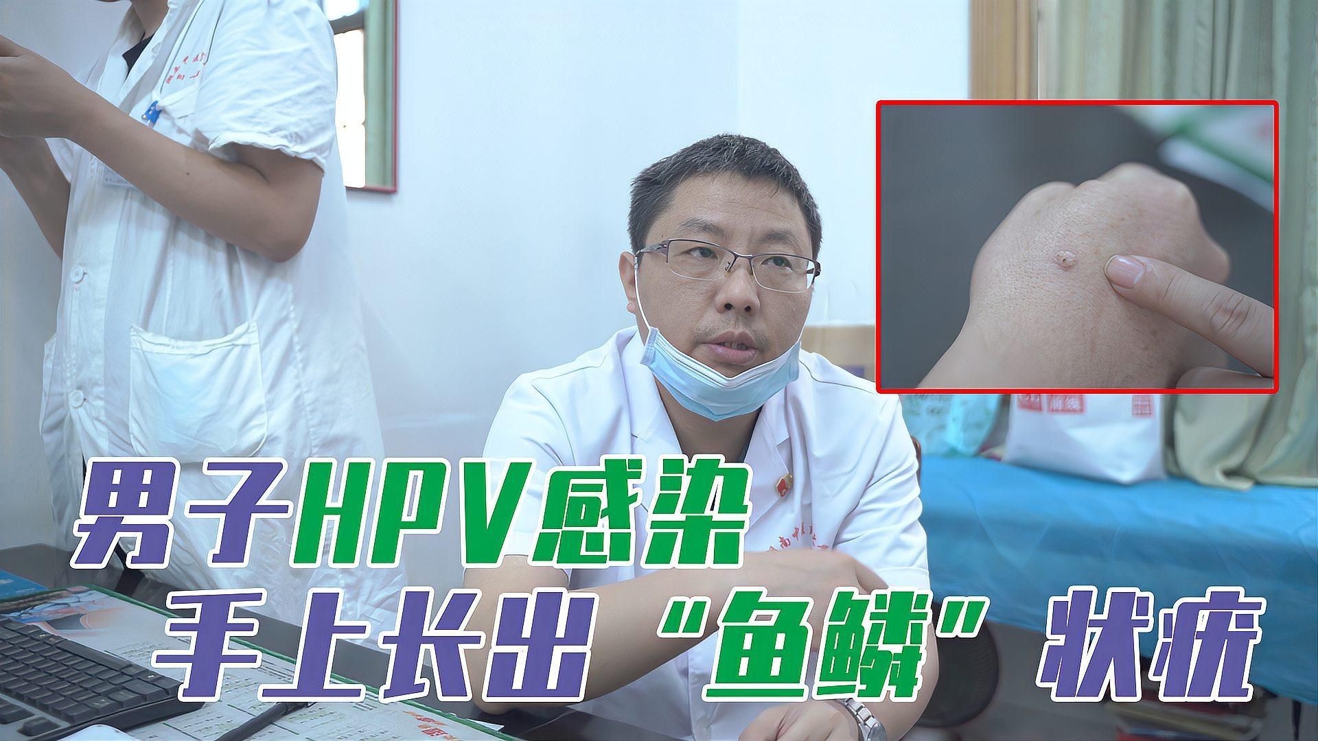 手上長魚鱗怎么去除掉