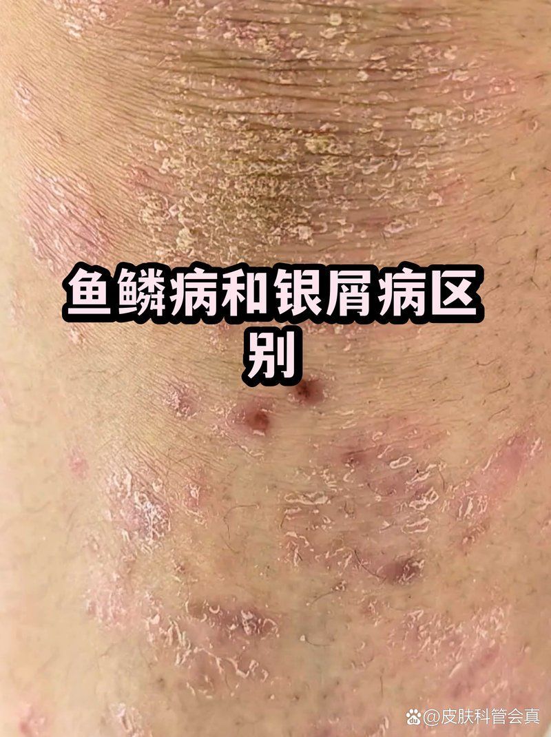 如何區(qū)分魚鱗病和銀屑病，魚鱗病和銀屑病的區(qū)別