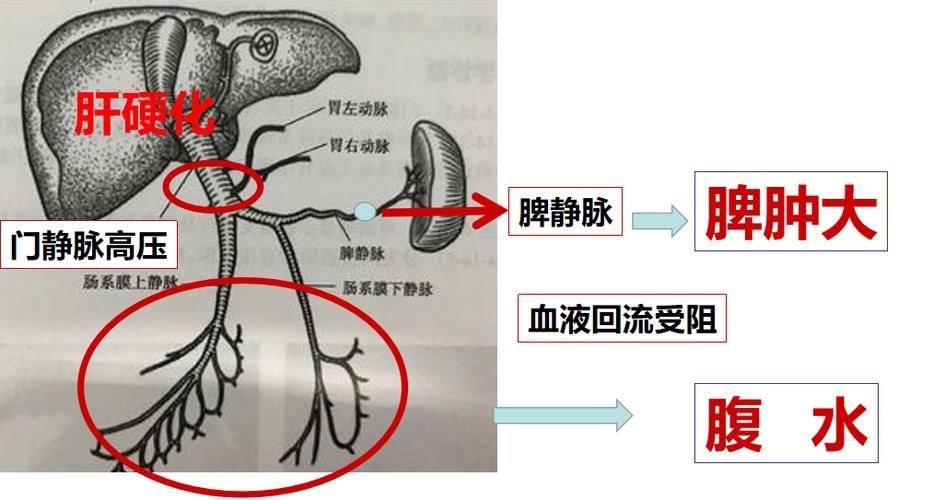 早期腹水病如何治療，早期腹水病治療流程圖