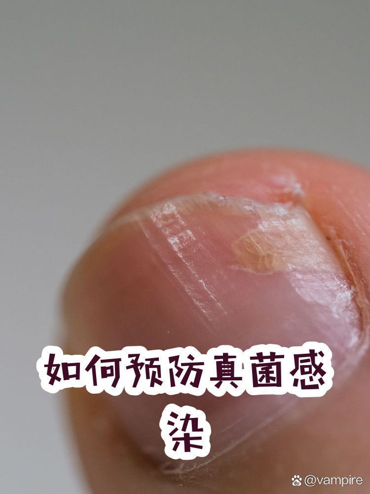 如何預防深部真菌感染，深部真菌感染的預防措施