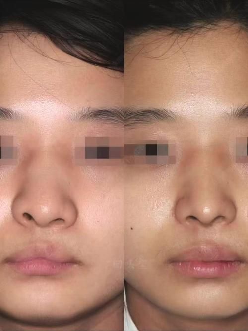 手術矯正龍魚嘴需要多長時間恢復？，手術矯正“龍魚嘴”