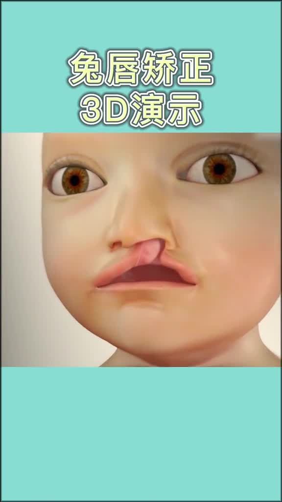 手術矯正龍魚嘴需要多長時間恢復？，手術矯正“龍魚嘴”