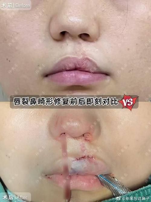 手術矯正龍魚嘴需要多長時間恢復？，手術矯正“龍魚嘴”