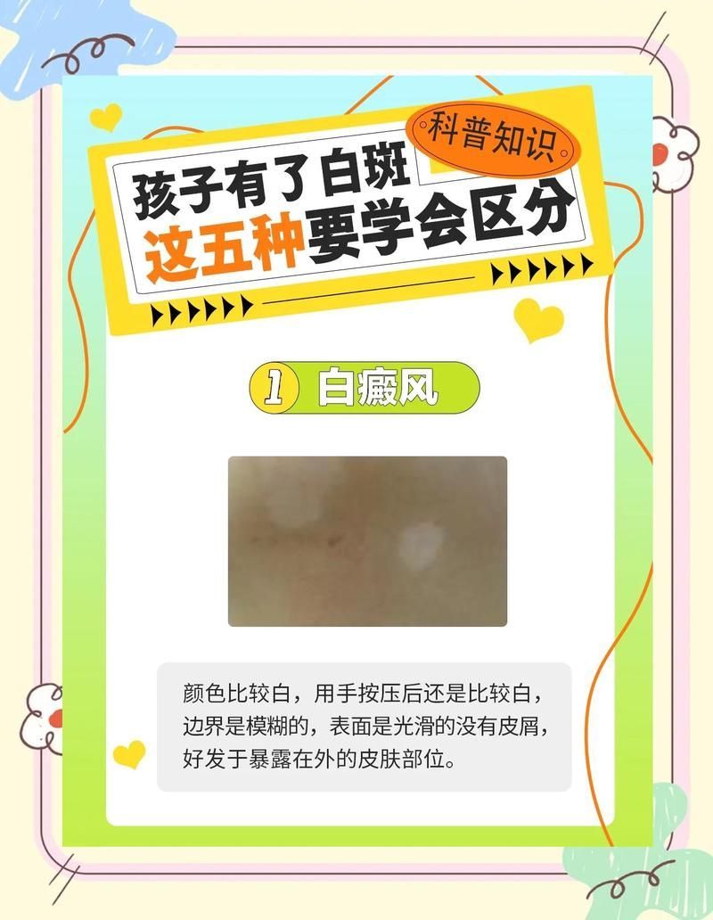 白點病有哪些典型癥狀，晶視光坊，6種白斑病辨別方法，簡單又實用