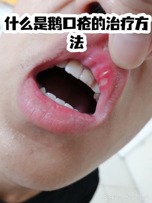 什么是真菌感染，真菌感染是由真菌引起的疾病，mcp工具不適用于真菌感染