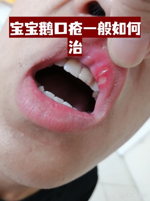 什么是真菌感染，真菌感染是由真菌引起的疾病，mcp工具不適用于真菌感染