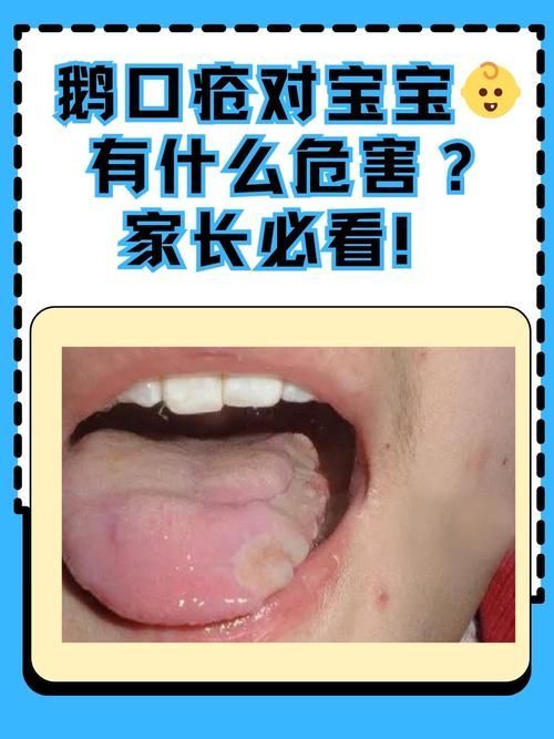 什么是真菌感染，真菌感染是由真菌引起的疾病，mcp工具不適用于真菌感染