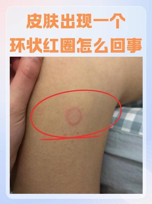 什么是真菌感染，真菌感染是由真菌引起的疾病，mcp工具不適用于真菌感染