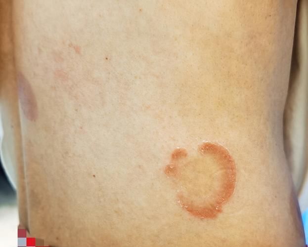 什么是真菌感染，真菌感染是由真菌引起的疾病，mcp工具不適用于真菌感染