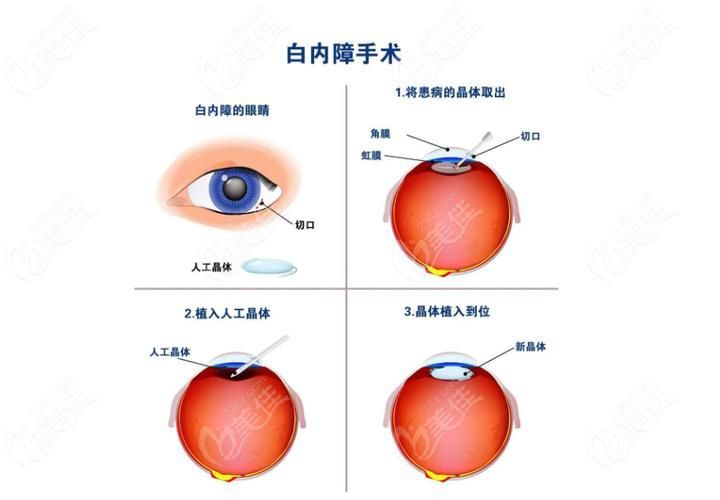 蒙眼病如何治療，百度健康-去問診,