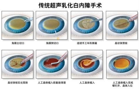 蒙眼病如何治療，百度健康-去問診,