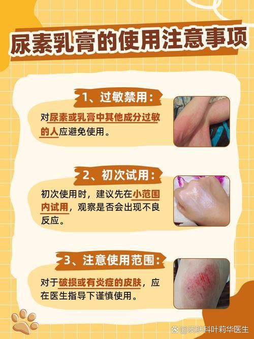 有哪些藥物可以預防松鱗病復發，尿素乳膏、乳酸、維a酸、維a酸乳膏、維a酸乳膏、阿維a