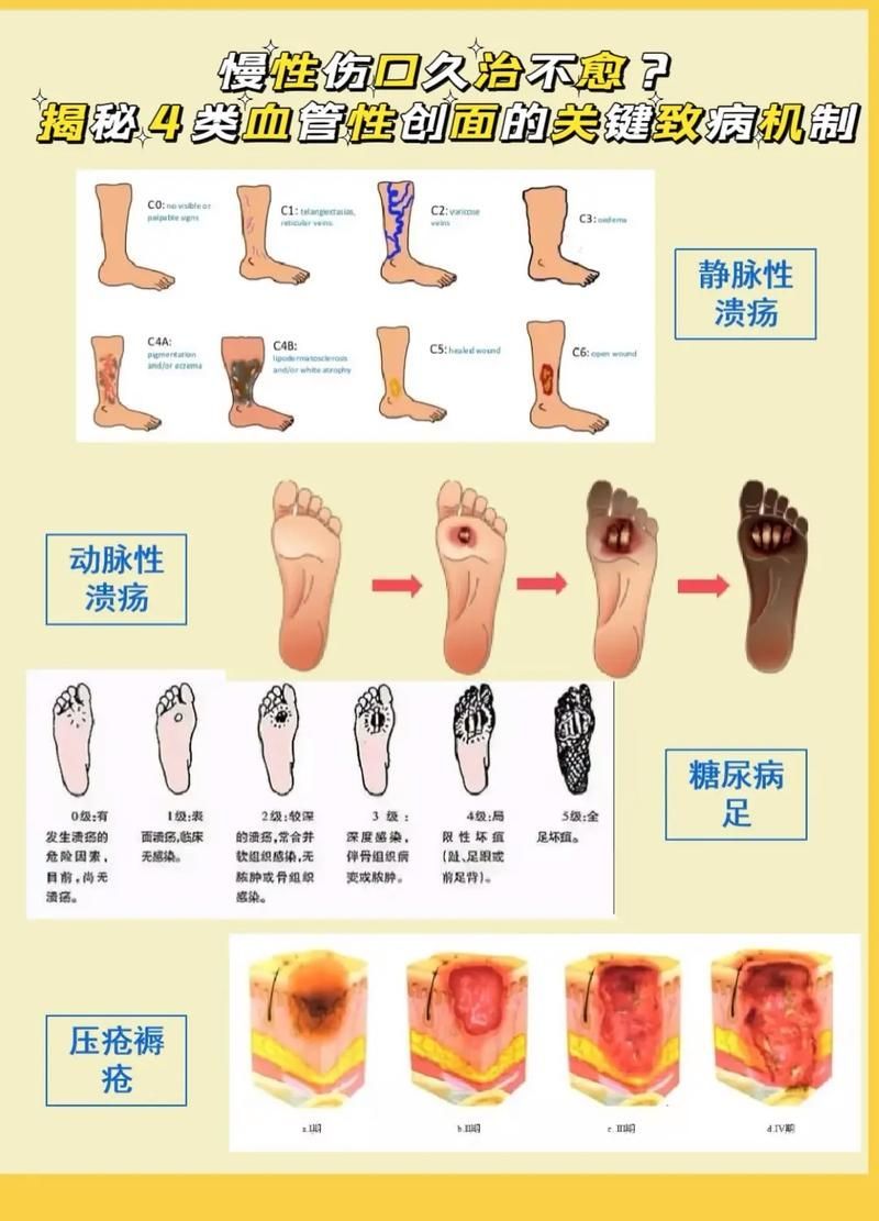 非感染性爛尾如何護理，“非感染性爛尾”如何護理