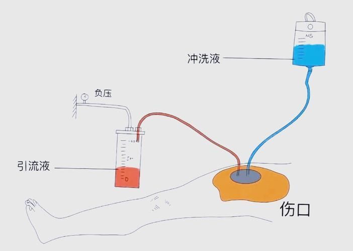 非感染性爛尾如何護理，“非感染性爛尾”如何護理