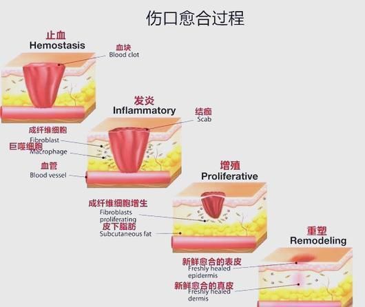 非感染性爛尾如何護理，“非感染性爛尾”如何護理